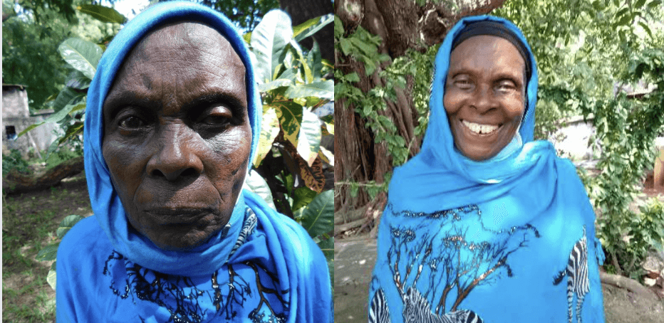 Før og etter operasjon av grå stær